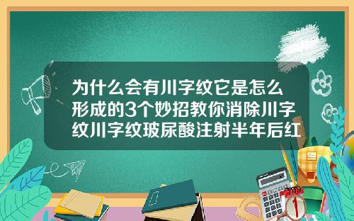 为什么会有川字纹它是怎么形成的3个妙招教你消除川字纹川字纹玻尿酸注射半年后红肿